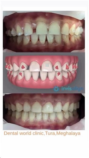Amazing transformation with Invisalign Aligners|Dental World Clinic|Tura #aligner #invisalign