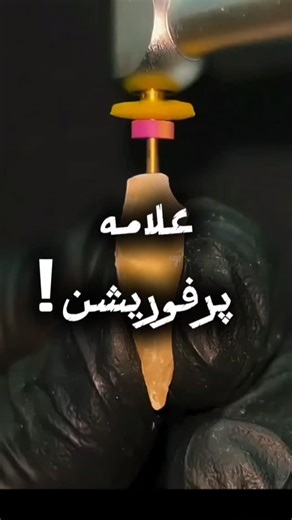 ‎کلینیک دندان فخری‎ on Instagram‎: "Dental tips ✅ چطور سوراخ‌شدن ریشه (Perforation) را هنگام فایل‌کردن احساس کنیم؟ اگر مسیر کانال ناگهان باز شود و فایل شما ۲ یا ۳ میلی‌متر به‌طور سریع داخل کانال برود، بسیار احتمال دارد که فایل از ریشه خارج شده باشد. #دندان‌پزشکی #مکتب_دندان #اندو #تداوی_ریشه #اندودنتیست Credit @dental_university_online @dr_wares_fakhri"‎