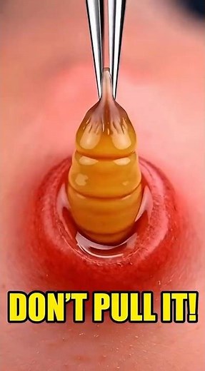 Why You Should NEVER Pull This Out 🐛 #shorts