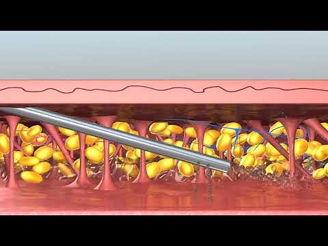 Lipo Vaser - mecanismo de acción / Dr. Percy Nuñez Villar