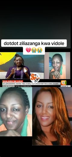 Understanding Gladys Njeri's Scleroderma Experience