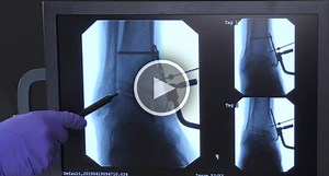 Medial Malleolus Fracture Treatment Using the Ankle Hook Plate with Richard Marks, MD