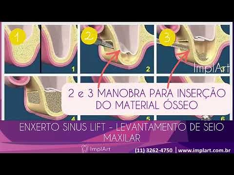 ENXERTO ÓSSEO SINUS LIFT - levantamento do seio maxilar para Implante dentario