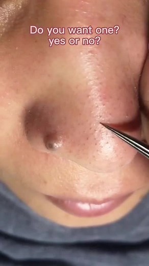 #skincare #cystpopping #satisfying #removal #acne #pinplepop #pinplepopping #pinplepopper2021 #pinplepopper #pimple #fyp #tiktok