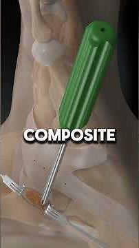 Arthrex Broström Repair Implant System