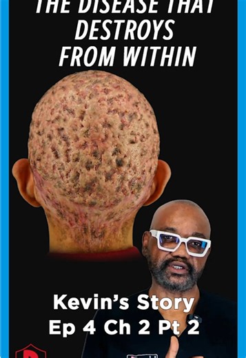 People called it a barber rash. But Kevin’s condition was much deeper than that. In this chapter, Dr. U explains how dissecting cellulitis can overlap with hidradenitis suppurativa, severe cystic acne, and other inflammatory diseases. And despite what people assume, it’s not contagious. That misunderstanding alone keeps a lot of patients hiding. Dr. U also explains how scalp trauma, infections, and unsanitary barber tools may make the condition worse once it starts. This is why chronic scalp dis