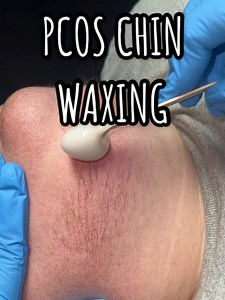 1M views · 17K reactions | PCOS/Hirsutism chin wax with Bushbeads wax by Bushbalm Professionals 懶Some clients skin are so sensitive. You literally can only go over the area once and have to tweeze the remaining hairs if there’s any. #fyp #pcos #hirsutism #wax #satisfying #sensitiveskin #waxing #bushbalmpro #trending #esthetician #reelsvideo #fblifestyle | Waxing Queen | Facebook