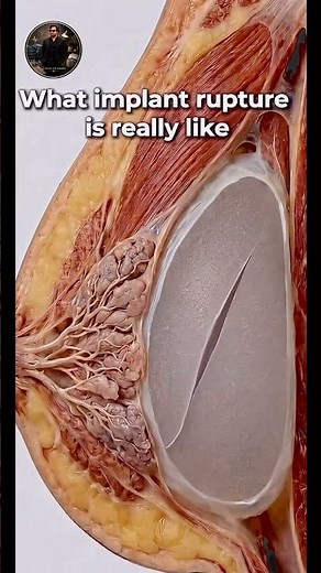 Artificial breast implants !!⚠️ how REPTURE breast looks !#womenshealth #mbbs #gynaecologist #mbbs