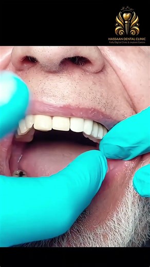 UK Couple Travels to Pakistan for Dental Implants 🇬🇧 | Honest Review at Hassaan Dental Clinic