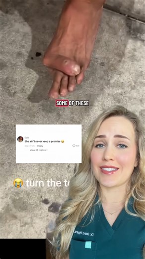 Dr. Dana Figura, DPM on Instagram: "This shows how dramatically the big toe can shift when the joint loses stability over time! #bunion #podiatry #surgeon #doctorexplains"