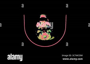 Coloured axial computed tomography (CT) scan through the head and brain of a patient with Dandy-Walker syndrome Stock Video Footage - Alamy