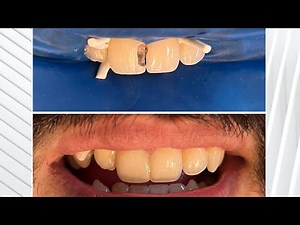 Anterior aesthetic restoration |Class 3 cavity preparation and composite restoration