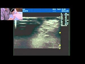 Ultrasound guided ankle block part 2: Sup/deep peroneal(fibular) nerves and saphenous nerve