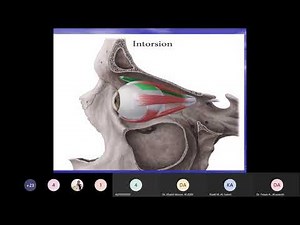 strubismus lecture dr. fawaz al sarayreh
