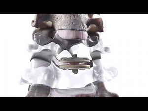 Simplify™ Cervical Disc