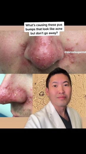 Understanding Demodex Mites: Causes and Treatment