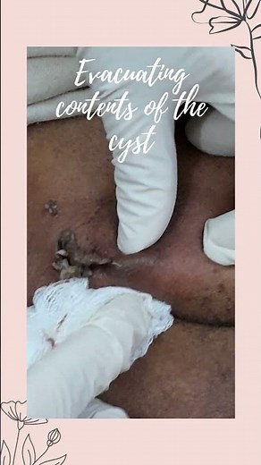 Sebaceous Cyst Drainage & Removal #skincare #dermatology #dermatologist