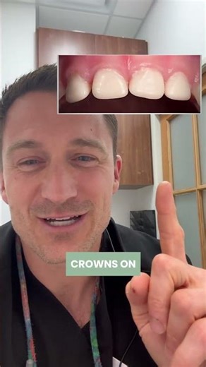 Crowns with no numbing, no drilling and no sedations.