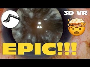 3D Phaco Clip #129 - Jacobovitz Chopper vs Nigra (VR Headset Version)