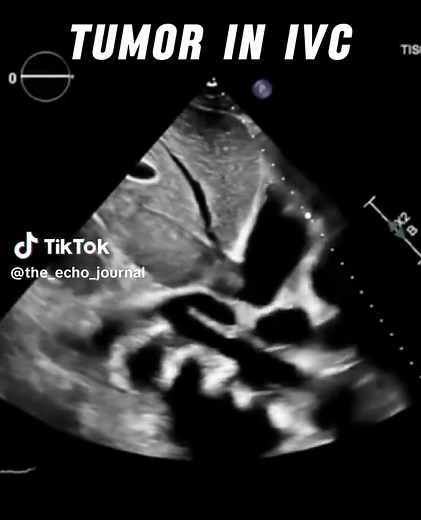 Renal cell carcinoma (RCC) on echocardiography typically presents as a mobile, often pedunculated, hyperechoic mass extending from the inferior vena cava (IVC) into the right atrium (RA) 📖 Advance your adult echocardiography expertise with weekly case breakdowns aligned with current guidelines to improve your scanning and reporting ⬇️ Join the newsletter 💌 Link is in our Instagram bio 🫀