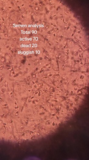 Understanding Semen Analysis Results for Fertility
