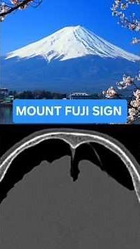 Have you seen this CT sign before🤔? " Mount Fuji sign " = life-threatening pneumocephalus