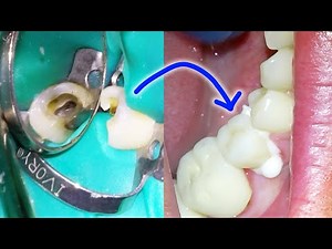 Full Root Canal & Crown Procedure w/ Post & Build-Up Placement Process • Video • MEDtube.net