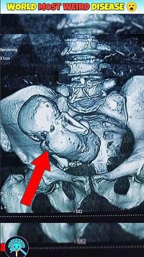 Stone Baby Found in Woman’s Womb After 34 Years