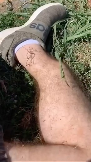 North American Rescue on Instagram: "🫣 Trauma Thursday from @savageparamedics Which of the following do you think caused this broken leg? The answer might SURPRISE you! 1. Fell from a homemade zip-line 2. Slipped while running down concrete steps outdoors 3. Golf cart rollover 4. Car accident 5. Skateboard accident 6. While riding a bike down a hill with shoes slung over the handlebars, shoe got caught in spokes of front wheel which brought the bike to an abrupt stop. He flew off the bike and o