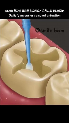 환자분 조금만 참으세요~ ASMR 충치치료 애니메이션 Satisfying caries removal animation #shorts