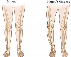 Η οστική νόσος Paget: Συμπτώματα και θεραπεία - HealthyLiving.gr