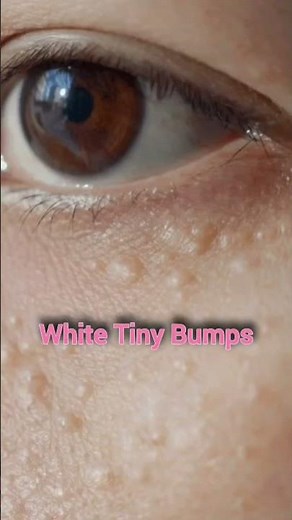 Types of Tiny Bumps on Face | They're NOT All the Same