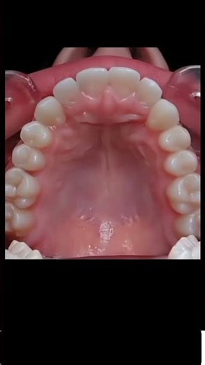 See how teeth are straightened 🥰 #dental Care#dentist#tiktok video