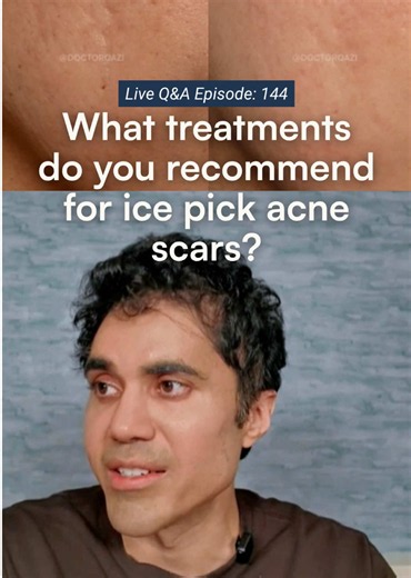 Ice pick scars are deceptively complicated. They look small on the surface, but they often run deeper than any laser can safely reach without destroying surrounding tissue. That is why we cannot simply laser down to the depth of the scar. Instead, we have a few different options when treating ice pick scars: First, oil control. Managing sebum production is critical because excess oil can enlarge pores and make ice pick scars appear more pronounced over time. Second, TCA CROSS. We place a custom 