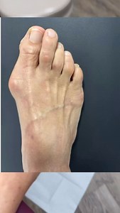 23 reactions | BUNION SURGERY BEFORE & AFTER this is my 70+...