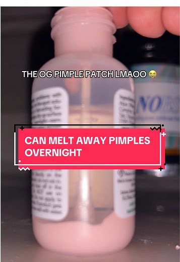 Literally worked wonders for my confidence #pimples #acne #skincare | calamine lotion acne