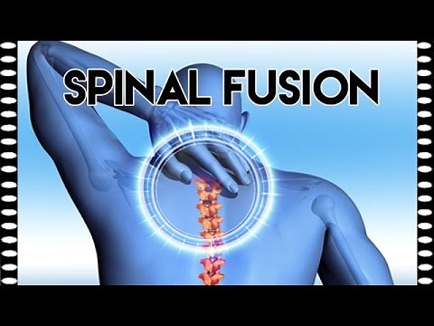 CCO CPC Exam Exercises — Spinal Fusion Practice Exam Question
