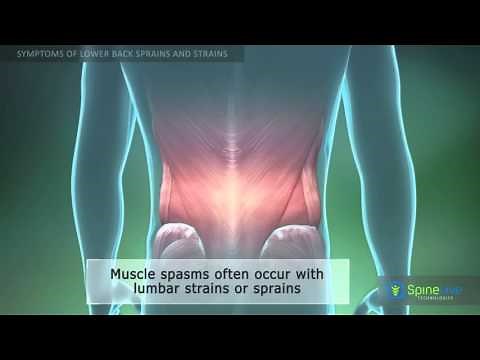 Lower Back Sprain and Strain Symptoms