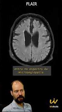 Microangiopathy - Gliosis on Magnetic Resonance Imaging - FLAIR
