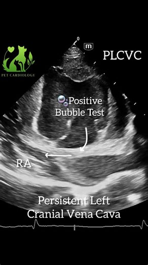 Pet Cardiology 💚 Dr.Carmen Vodă on Instagram: "In dogs🐶 dilated coronary sinus (CS) is not a diagnosis itself but a marker of abnormal venous return and/or elevated right-sided filling pressures Causes🔍 : 🟢 Persistent left cranial vena cava (PLCVC) By far the most common cause of CS dilatation in dogs ✨️. If is an embryologic remnant of the left cranial cardinal vein that fails to regress and drains into the CS, which then empties into the right atrium. Often incidental, but can complicate: 