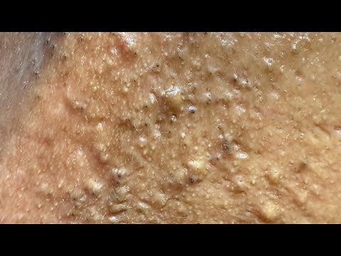 Tested The Best Pimple Remedies – Here's What Actually Works