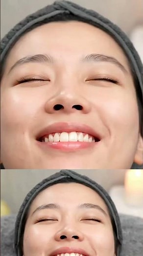 Popping Whiteheads with Vacuum 💥 Chin Extraction #pimplepopping #acne #whiteheads