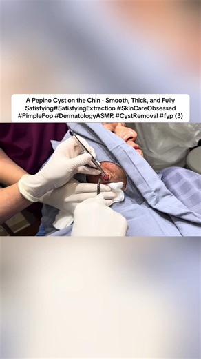 Pepino Cyst Removal on Chin: A Satisfying Extraction