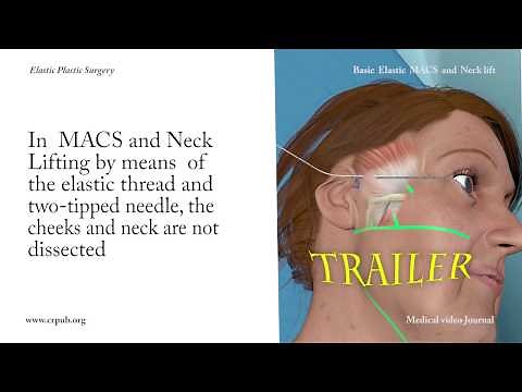 37) Basic Elastic MACS and Neck Lift without dissection of the cheeks and neck, step-by-step