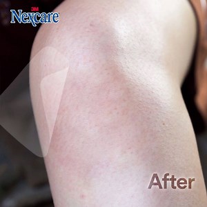 Gone are the days when bad falls or accidental scrapes leave unsightly marks that serve as nasty reminders on your skin. Let your wounds heal better and avoid scarring with the first-ever Nexcare™ Hydrocolloid Bandages! | Nexcare | Facebook