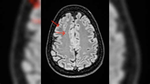 What to know about whole-body MRI scans