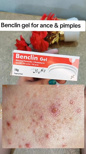 Benclin Gel for Acne and Pimples Treatment