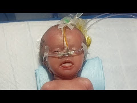 RN Talha NICU Babys Care is live!Preterm Baby in Critical Condition | Hydrocephalus and Intubation