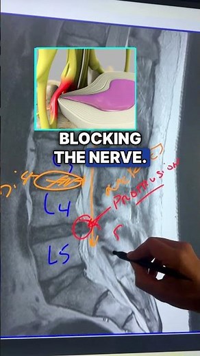 How spinal decompression cured 12mm disc protrusion—pain-free in 10 weeks!