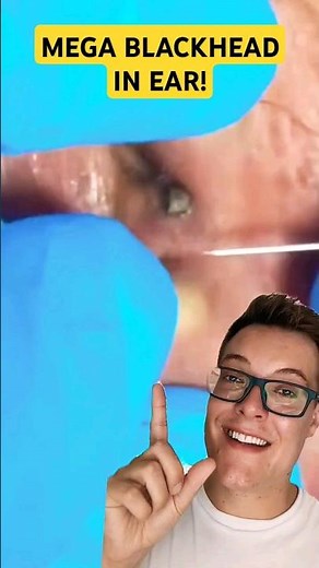 Enormous BLACKHEAD REMOVAL FROM EAR #shorts